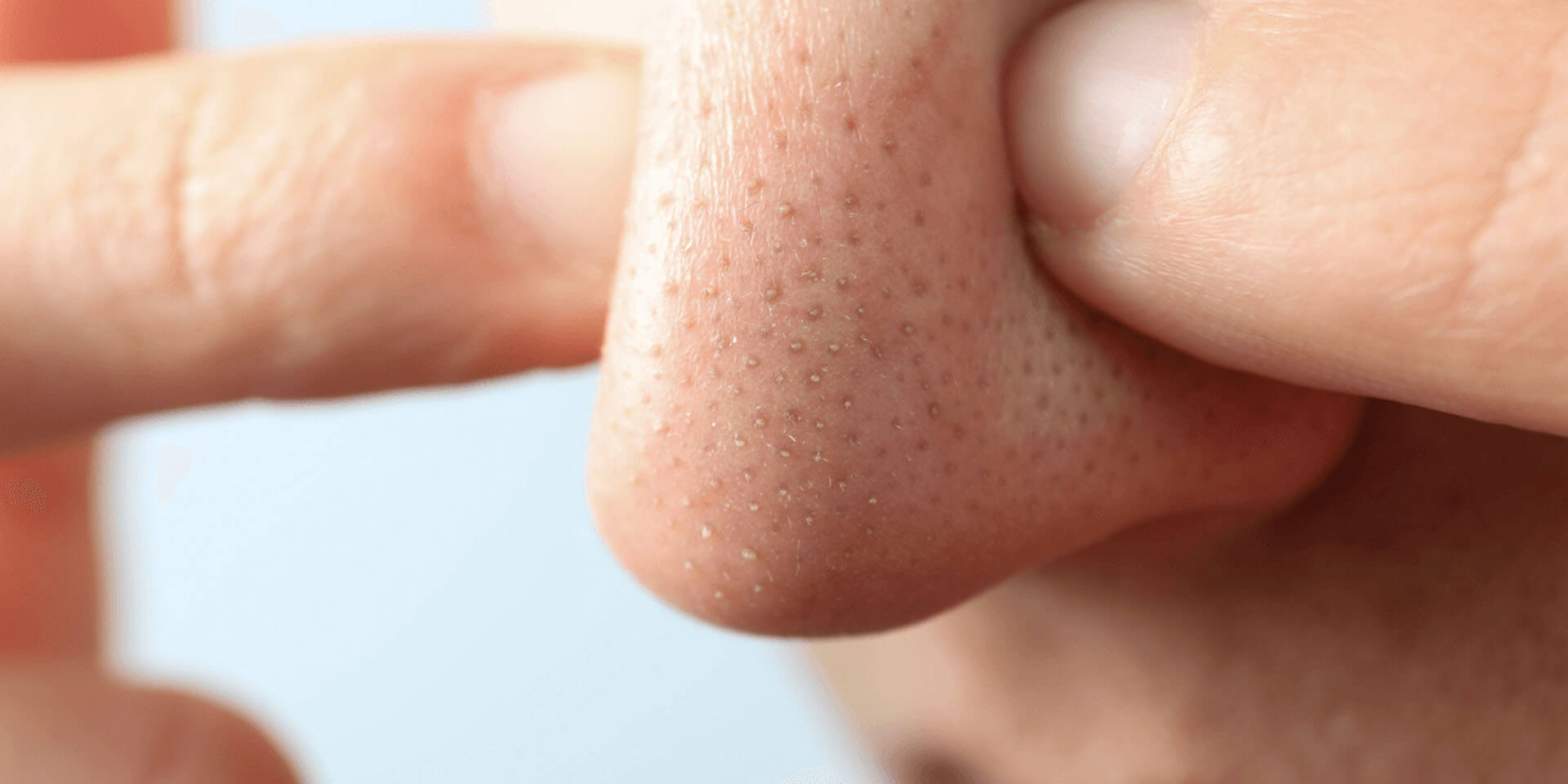 What are Blackheads & How are They Formed?
