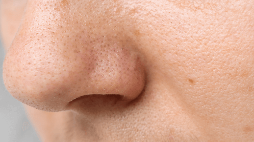 How Does Salicylic Acid Work on Acne